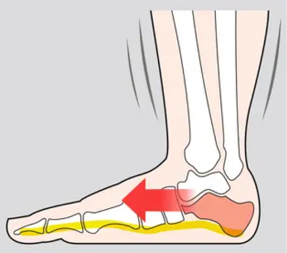 歪んだアーチの骨格図